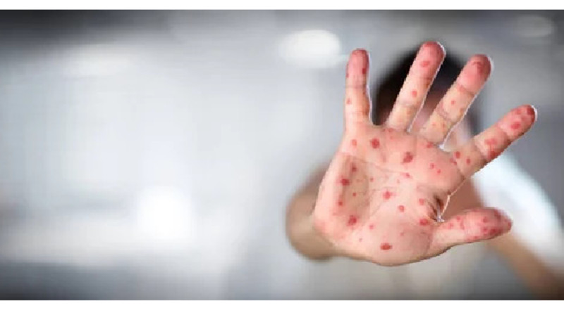 Қызылша жылдам таралып жатыр, көбі вакцина алмаған