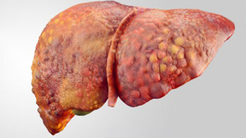 Бауырдағы артық майды кетірудің жолы табылды