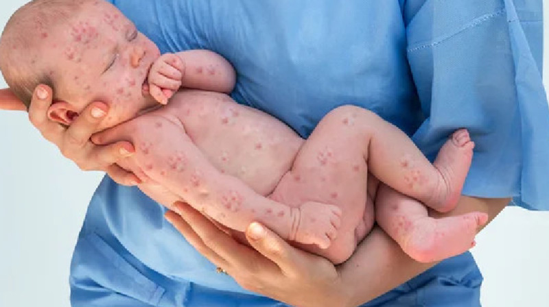 Қызылшаға қарсы вакцина басқа да жұқпалы аурулардан қорғайды