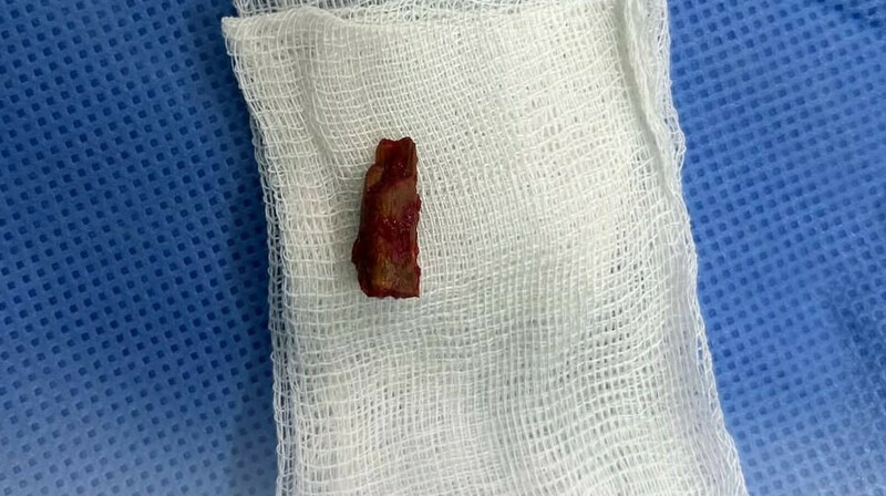 Павлодарда  баланың басынан 5 жыл бұрын кірген ағаш бұтағының қиындысы алынды