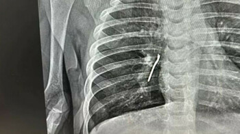 Ақтауда дәрігерлер сәбидің өкпесінен темір зат алып шықты