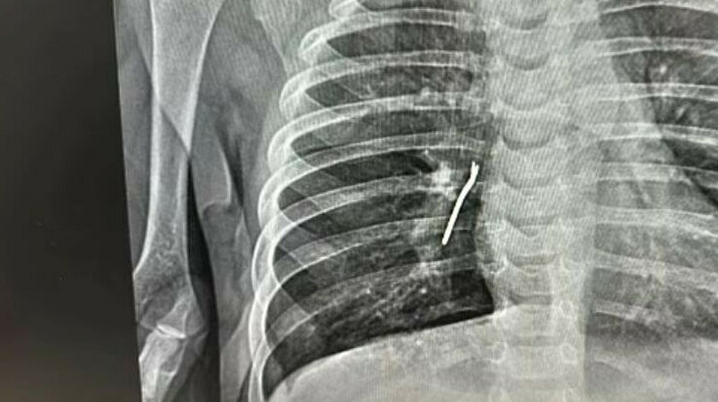 Ақтауда дәрігерлер сәбидің өкпесінен темір зат алып шықты