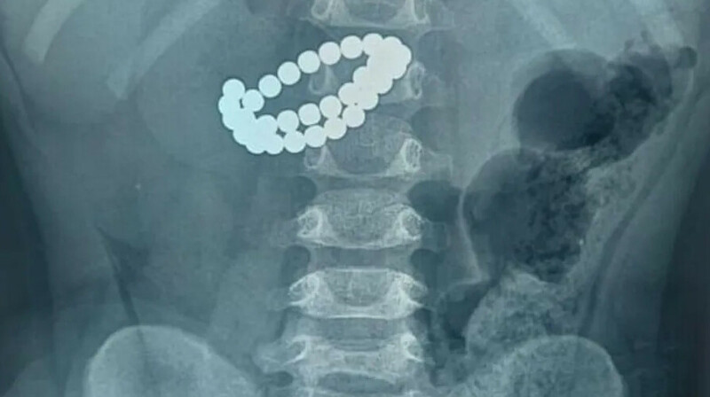 Алматыда бір жасар бала 31 магнит жұтып қойған